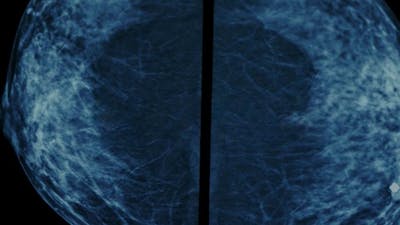 On Behalf of Our Breasts: The Dark Side of Screening