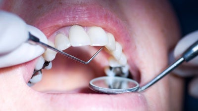 Anita Vazquez-Tibau on Mercury Free Dentistry