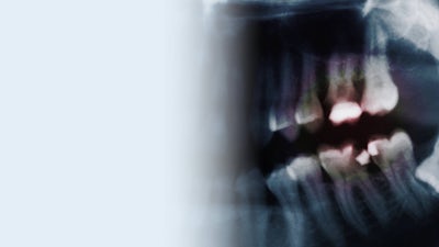 Dangers of Mercury in Your Mouth