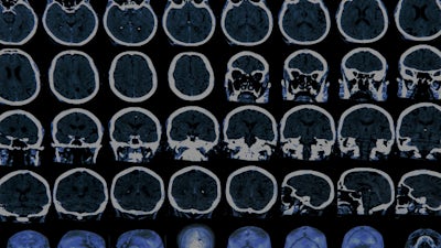 Mercury & Alzheimer's